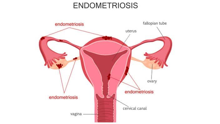 endometriosis