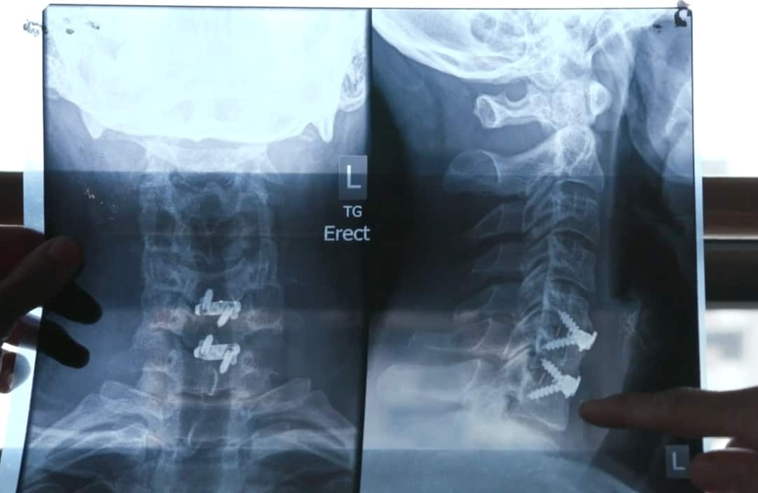Daniel's neck x-ray