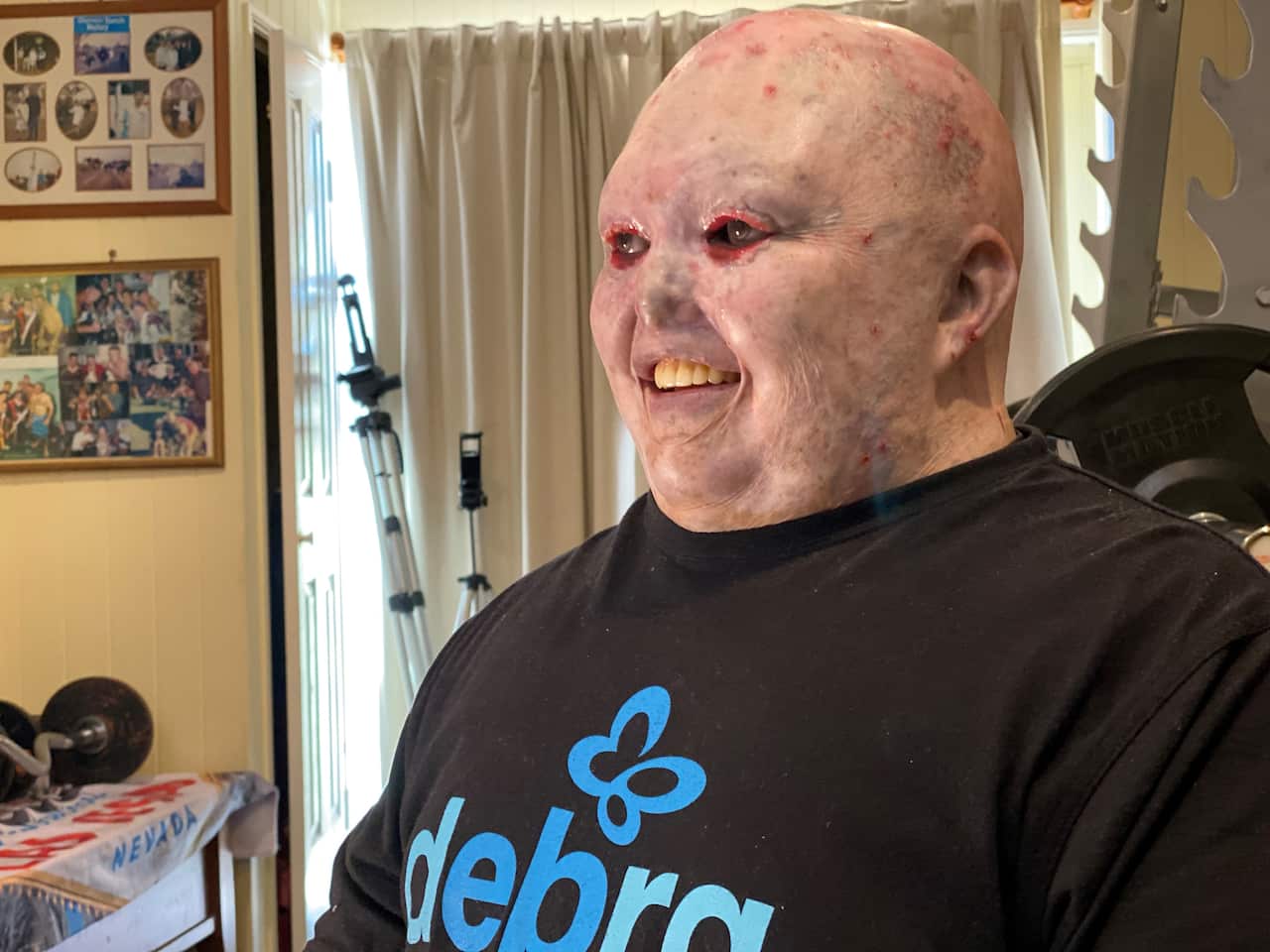 Dean Clifford, 40, is one of the oldest known people in the world living with Epidermolysis Bullosa.