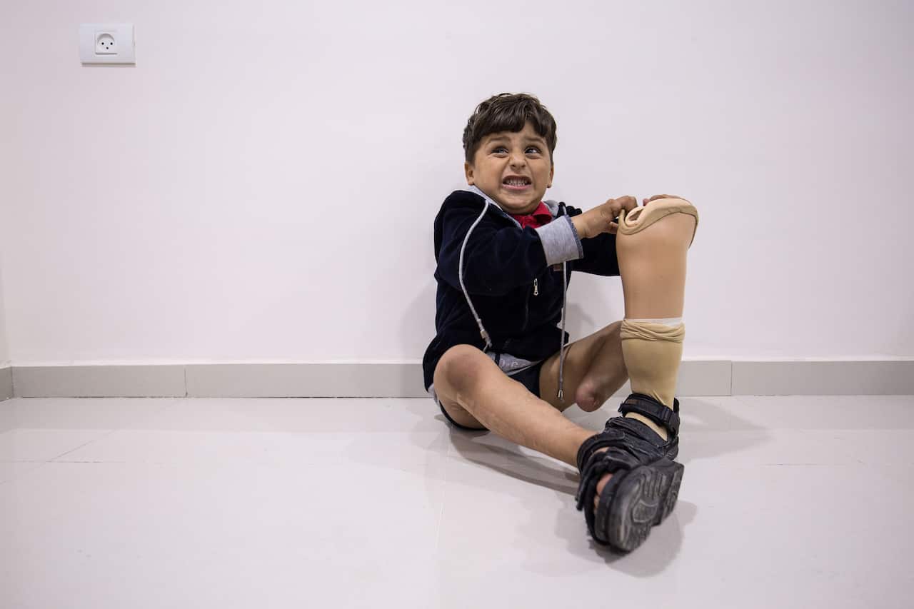 Wael’s son, Sharef, who is in the process of being fitted for a prosthetic leg