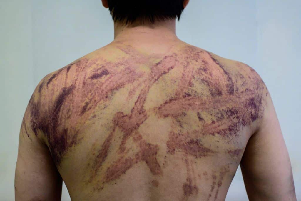 EDITORS NOTE: Graphic content / Calvin So, 23, a resident of the rural town of Yuen Long near the border with mainland China, shows his wounds and bruises in a hospital corridor in Hong Kong on July 24, 2019, after he was assaulted on his way back home fr