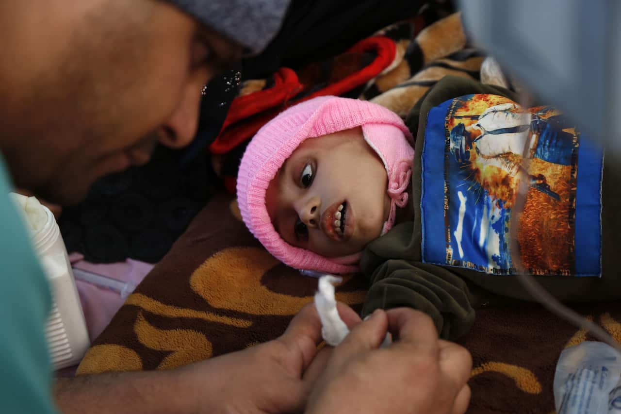 A Yemeni baby receives treatment at Sabeen Hospital on 13 January, 2021 in Sanaa, Yemen.