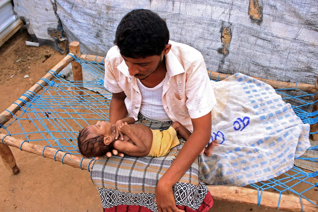 A four-year-old Yemeni child weighs just nine kilograms due to acute malnutrition, sleeps in his father's lap at a camp for the internally displaced people.
