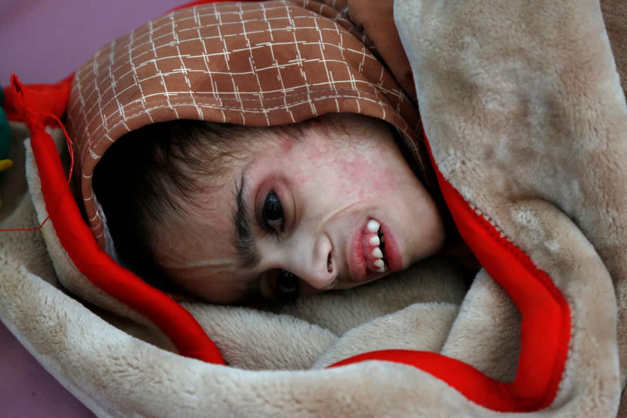 At least 98,000 children under five in Yemen are at high risk of dying without urgent treatment, according to the United Nations Children's Fund. 