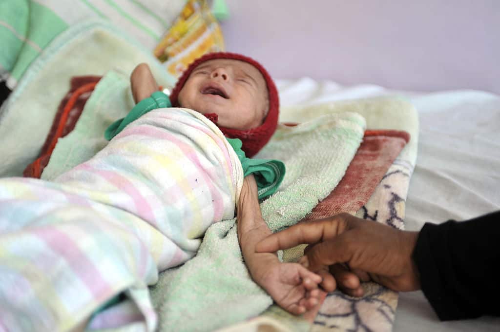  Yemeni malnourished infant cries as he leis on a bed at a therapeutic feeding center in al-Sabaen Hospital in Sanaa, Yemen,