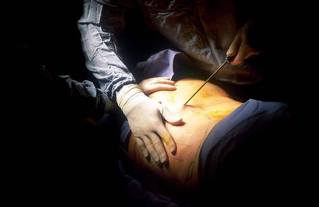 Liposuction surgery