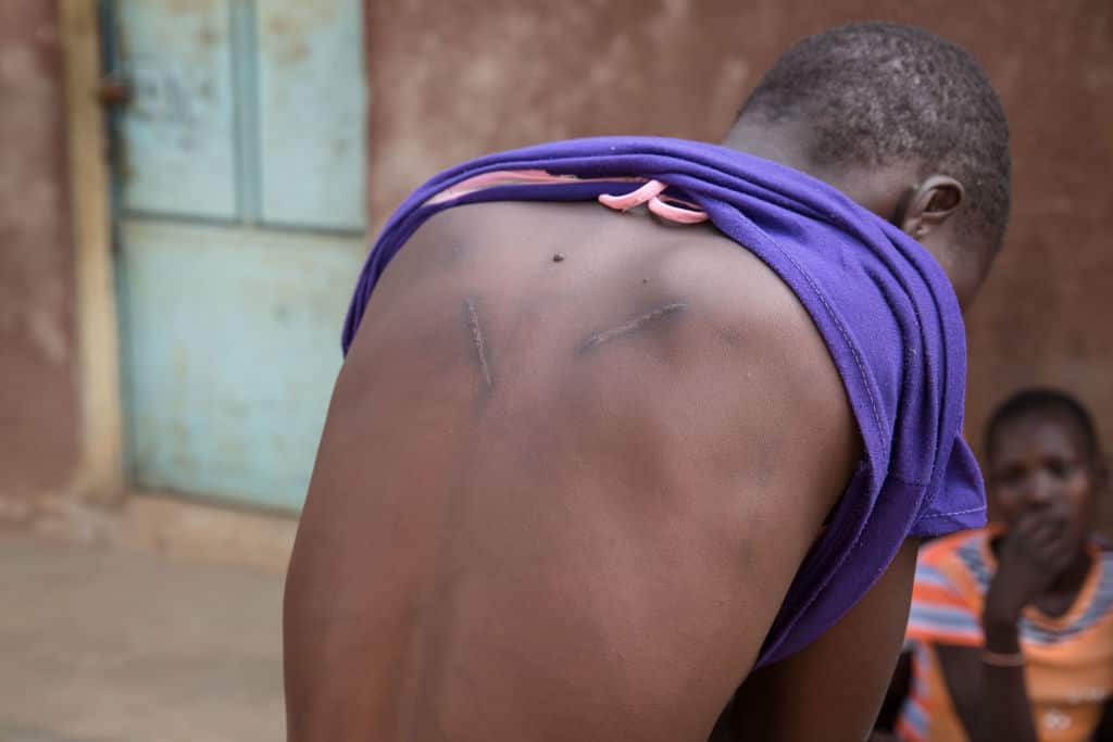 A 12-year-old shows scars she received when relatives beat her after she tried to escape from a marriage to a much older man.