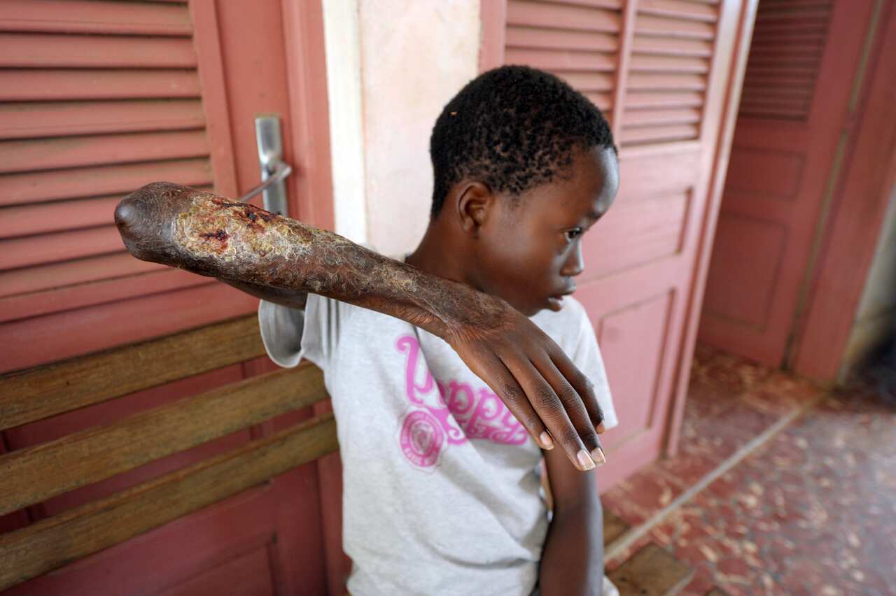A young boy in the Ivory Coast shows his arm skin damaged by Buruli ulcer, also known as the Bairnsdale ulcer or Searl ulcer, as he waits to get treatment on September 12, 2009.