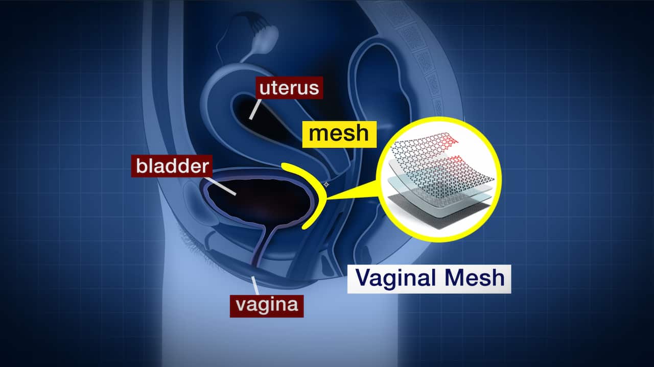 Vaginal mesh product