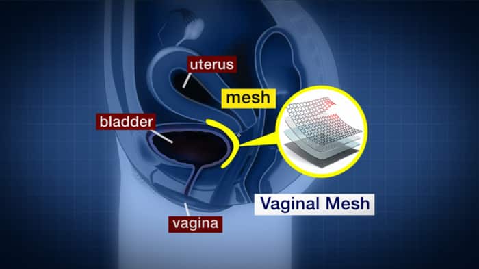 Vaginal mesh
