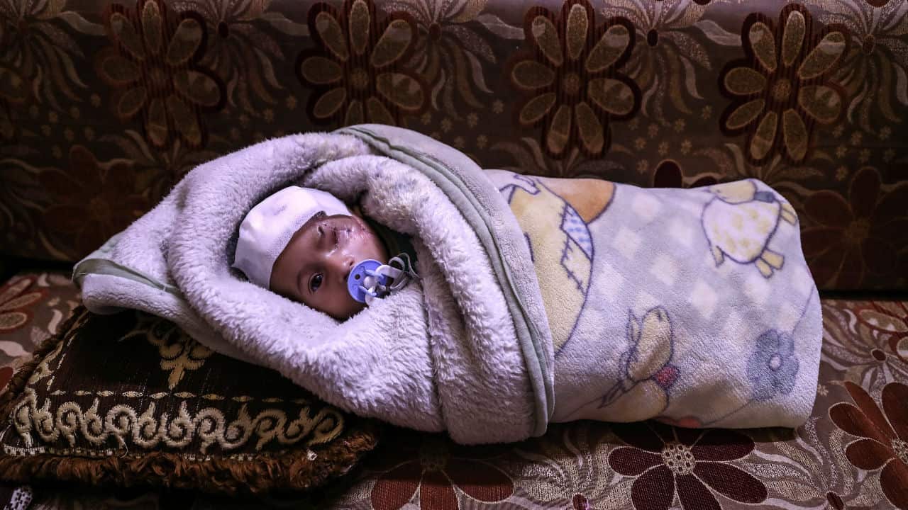 Karim, an infant who was injured twice from bombings on Eastern al-Ghouta, rebel-held Douma, Syria.