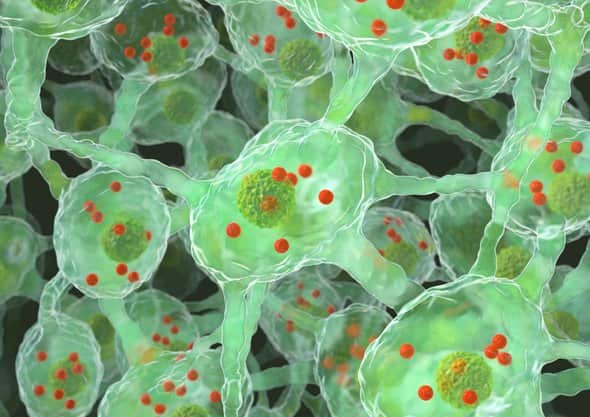 Computer artwork of a brain affected by Parkinson's