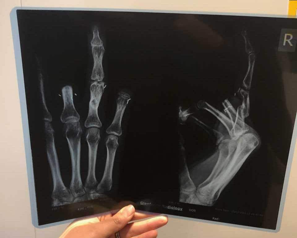 An x-ray of Ms Yun's hands.