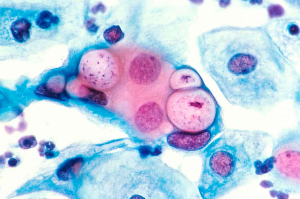 Human pap smear showing chlamydia in the vacuoles at 500x and stained with H&E (Getty Images)