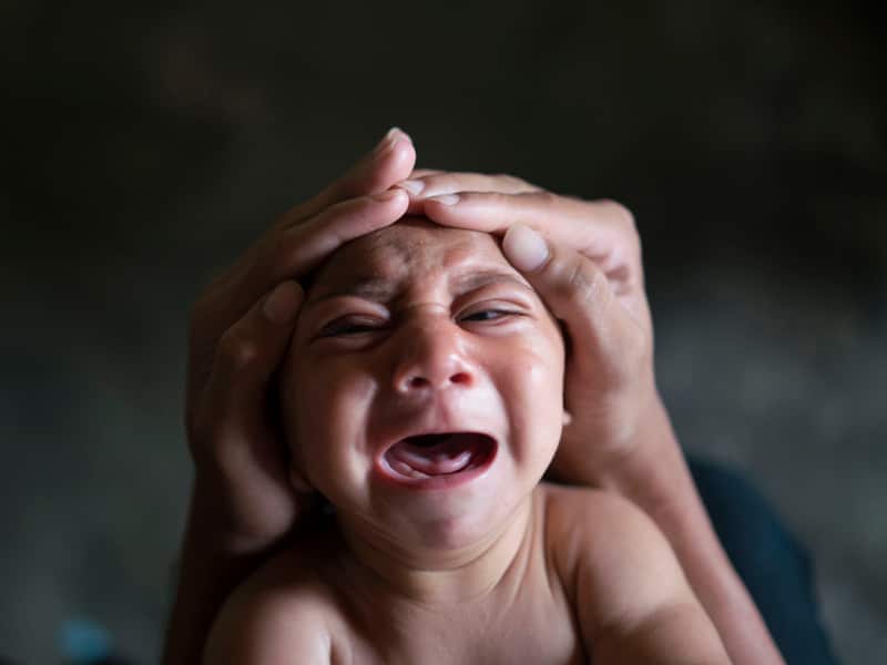 Jose Wesley, who was born with microcephaly