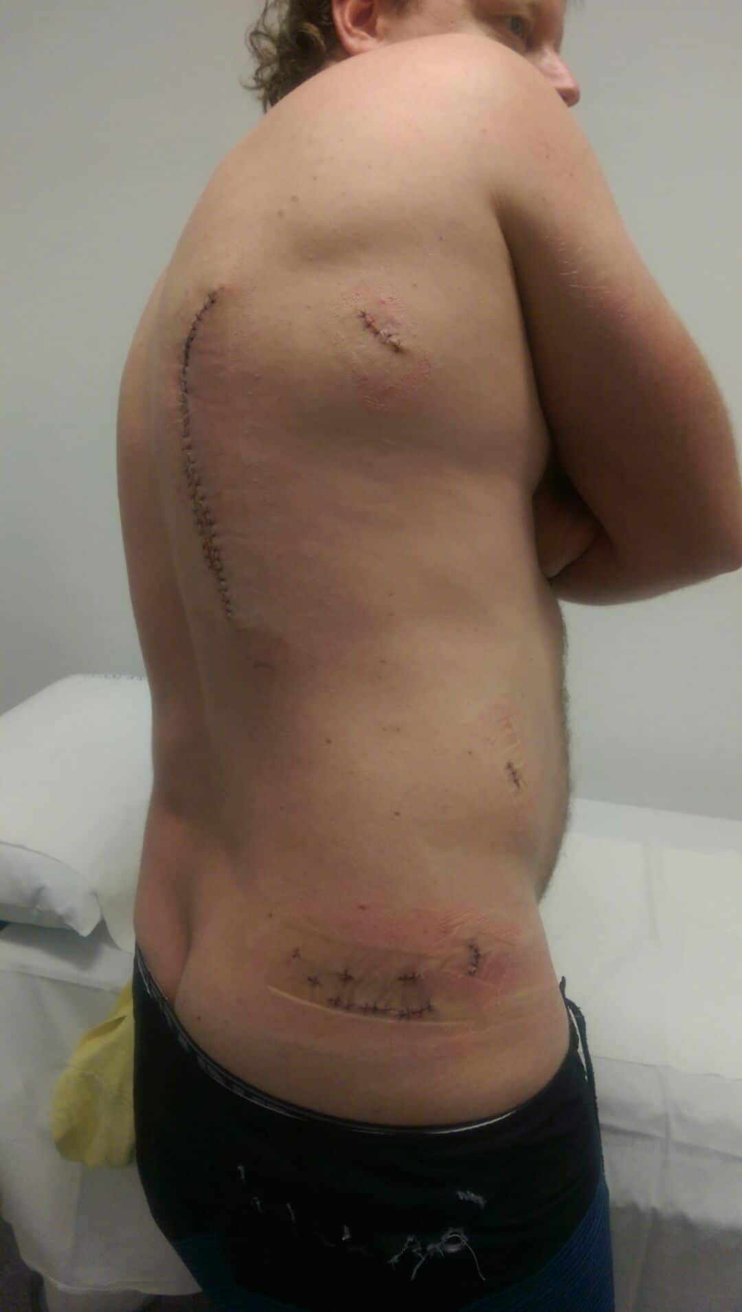 Jebez Reitman received 69 stitches after a shark "chewed on" him.