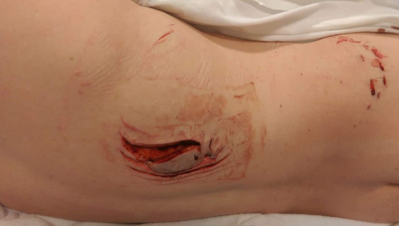 Jebez Reitman was attacked by a shark at Byron Bay in February 2015.