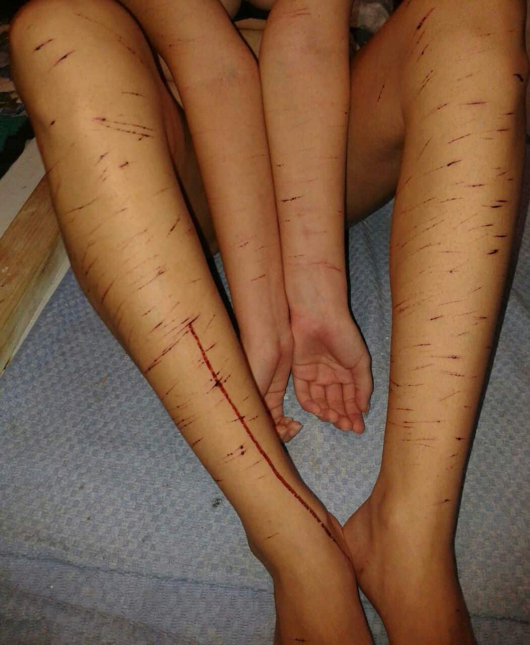 Nauru asylum seeker - Scarring on Jazmin’s legs and arms were noted by IHMS staff in documents obtained by SBS. 