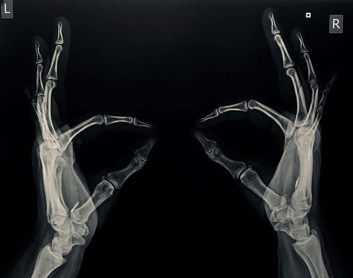 An x-ray of Kayla Heffernan's hands.
