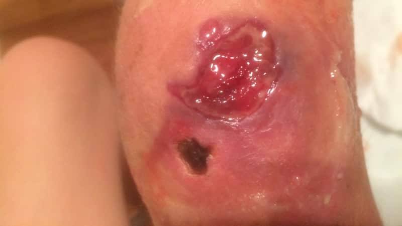 Ella Croft fighting mysterious flesh-eating bacteria.