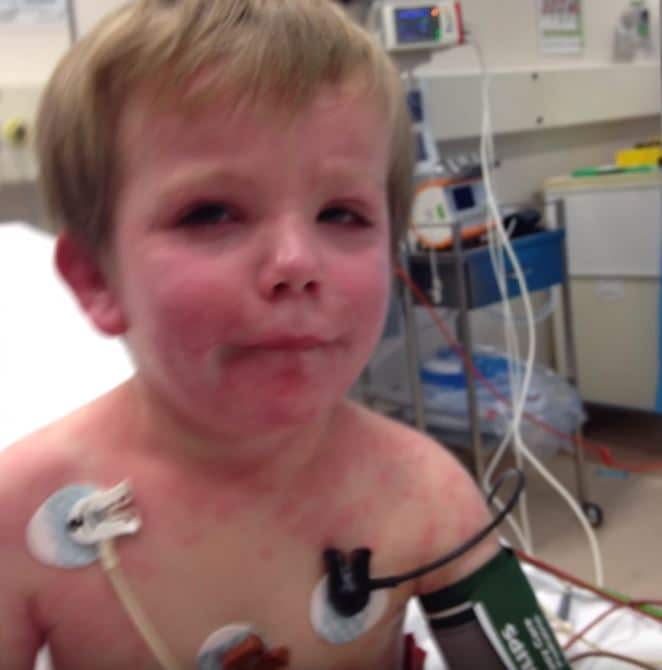 Deadly cluster of mammalian meat allergy