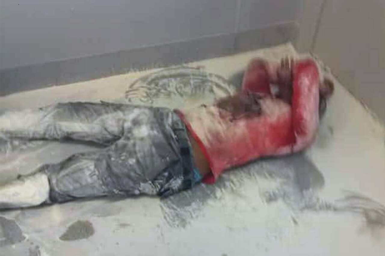 A 30-year-old Somalian man is coated in white fire-fighting chemical powder after he set himself on fire in East Lorengau camp.