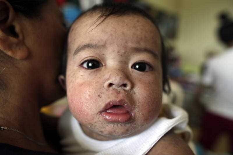 The Philippines health department declared a measles outbreak in Metro Manila and Central Luzon. At least 55 deaths have been recorded since 1 January.