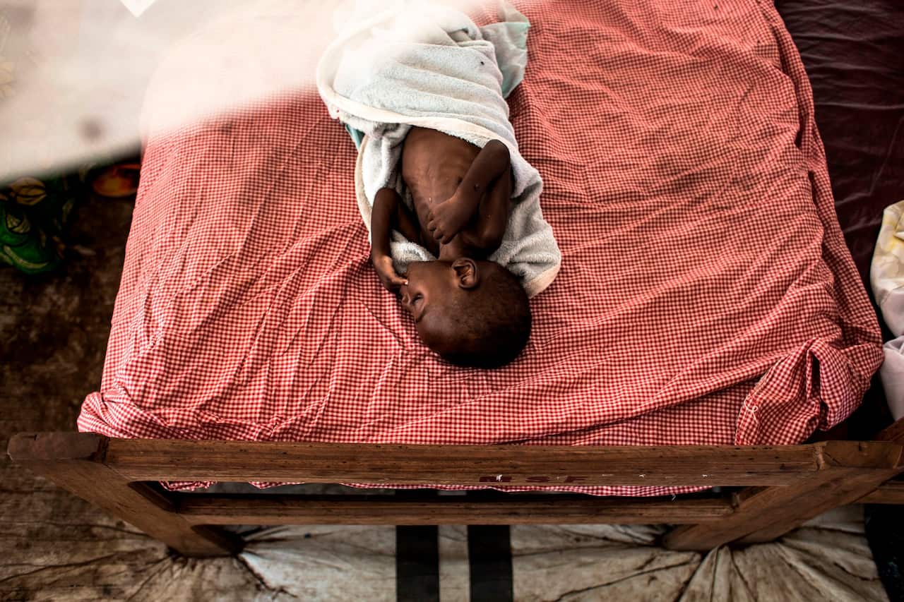 A severely malnourished child at a feeding and rehabilitation centre in Tshikapa, Congo, in October.