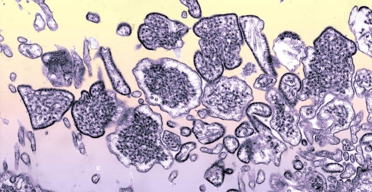 The Nipah virus in the Cerebrospinal fluid of an infected patient.