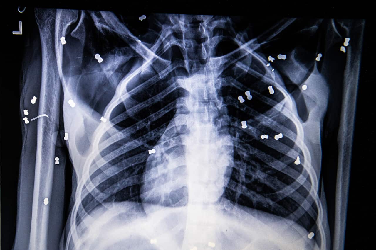 An X-ray showing air-rifle pellets inside Hope, the orangutan, outside the city of Medan, Indonesia.