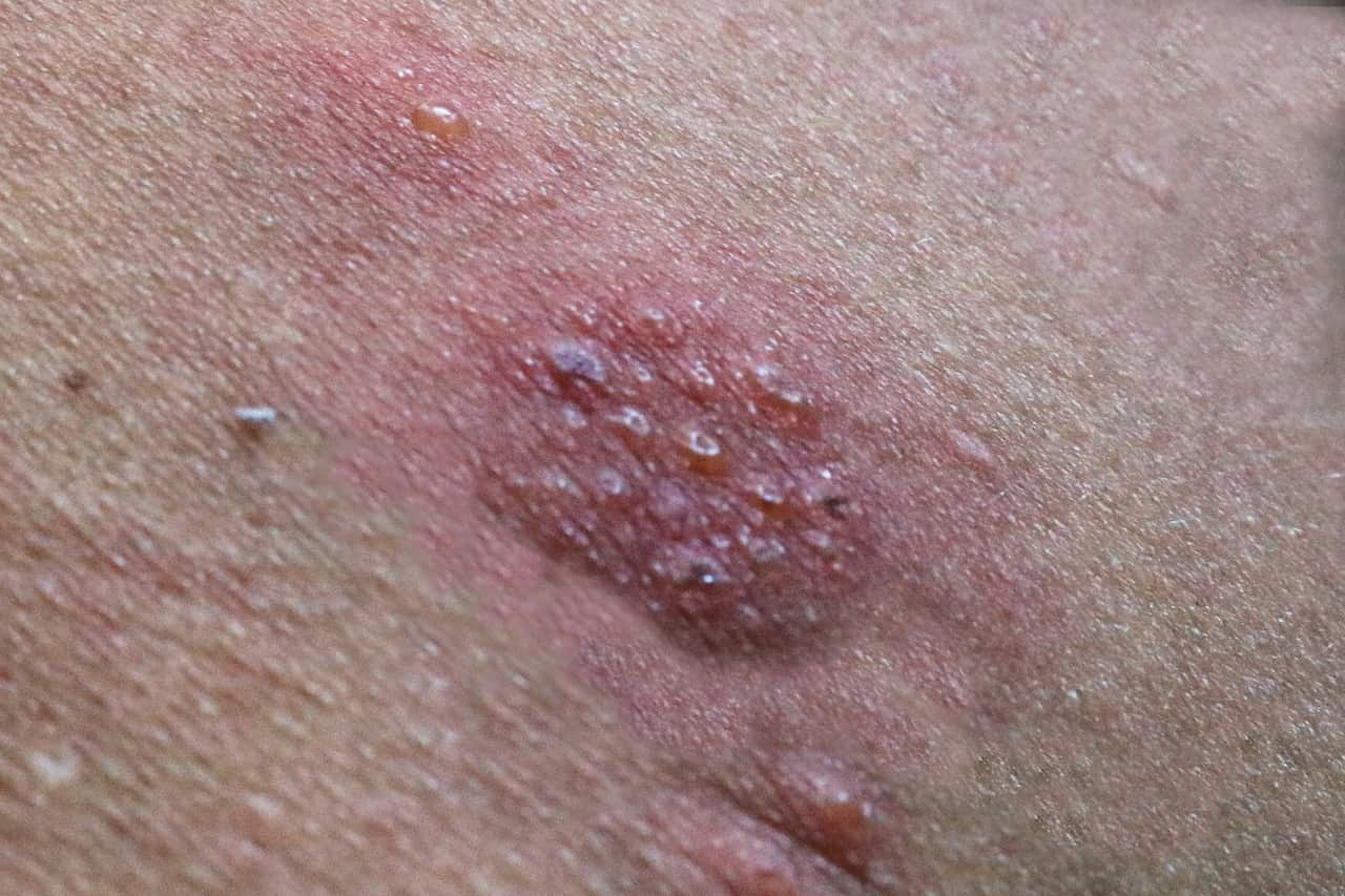 A round pink and red rash on human skin.
