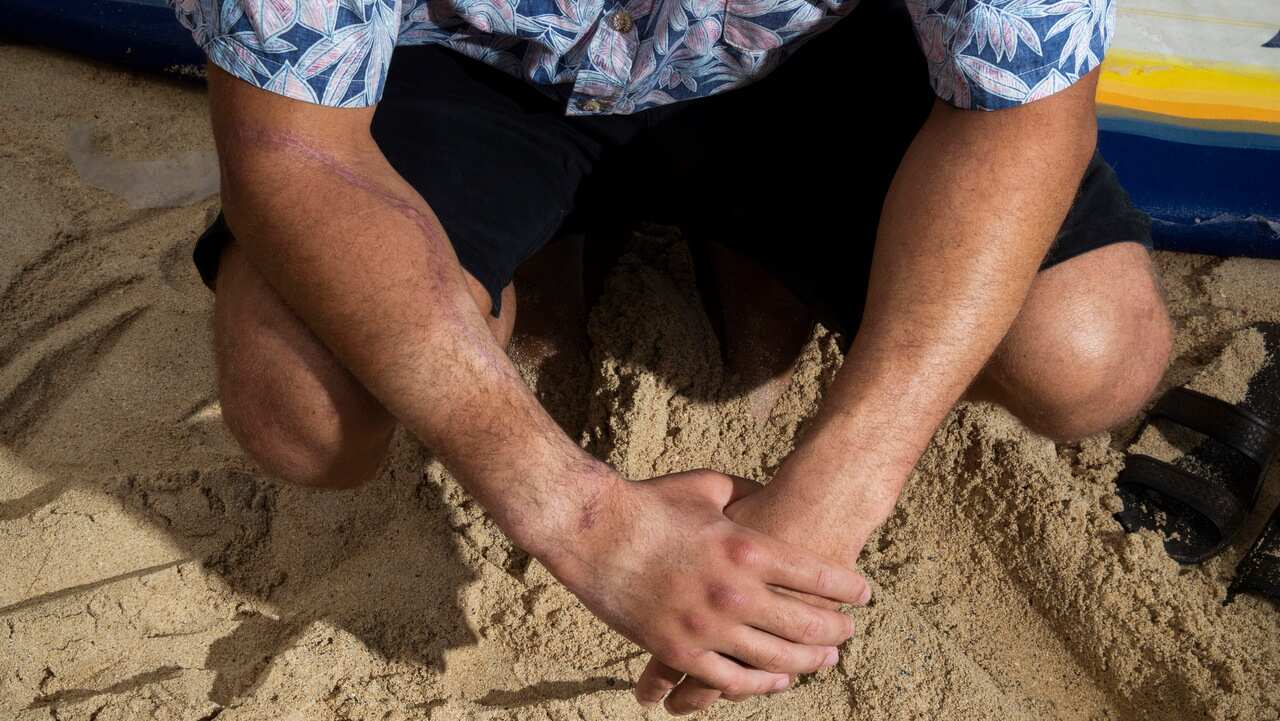 Juliun Perkins was bitten by a shark on Sept. 8, 2018, while surfing outside of Pounders in Laie, Hawaii.