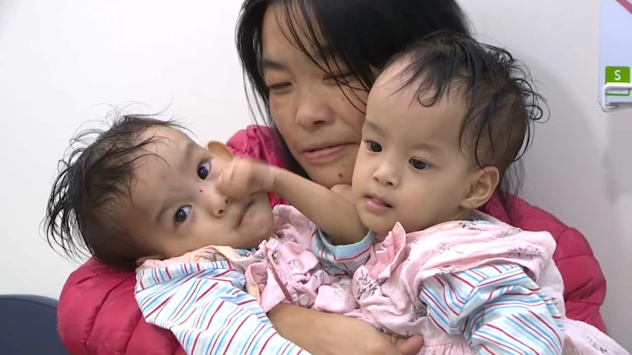 Bhutanese twins Nima and Dawa were separated by doctors.