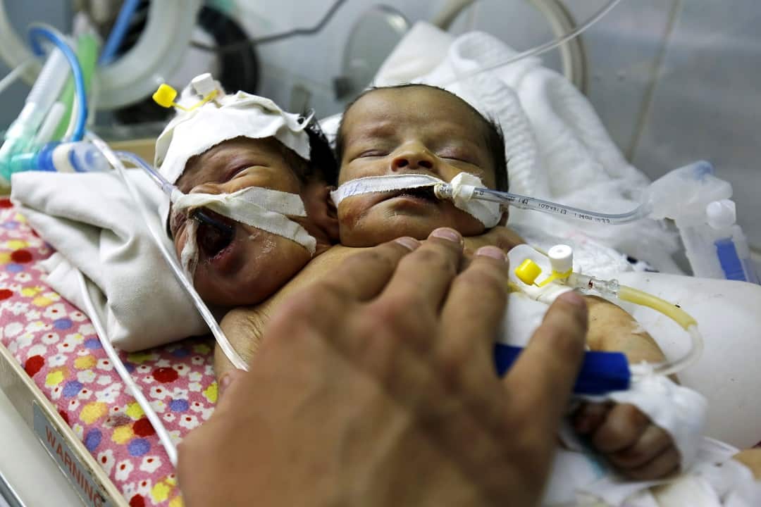 A Yemeni medic checks up on conjoined newborn twins, Abdul-Khaliq (right) and Abdul-Rahim (left).