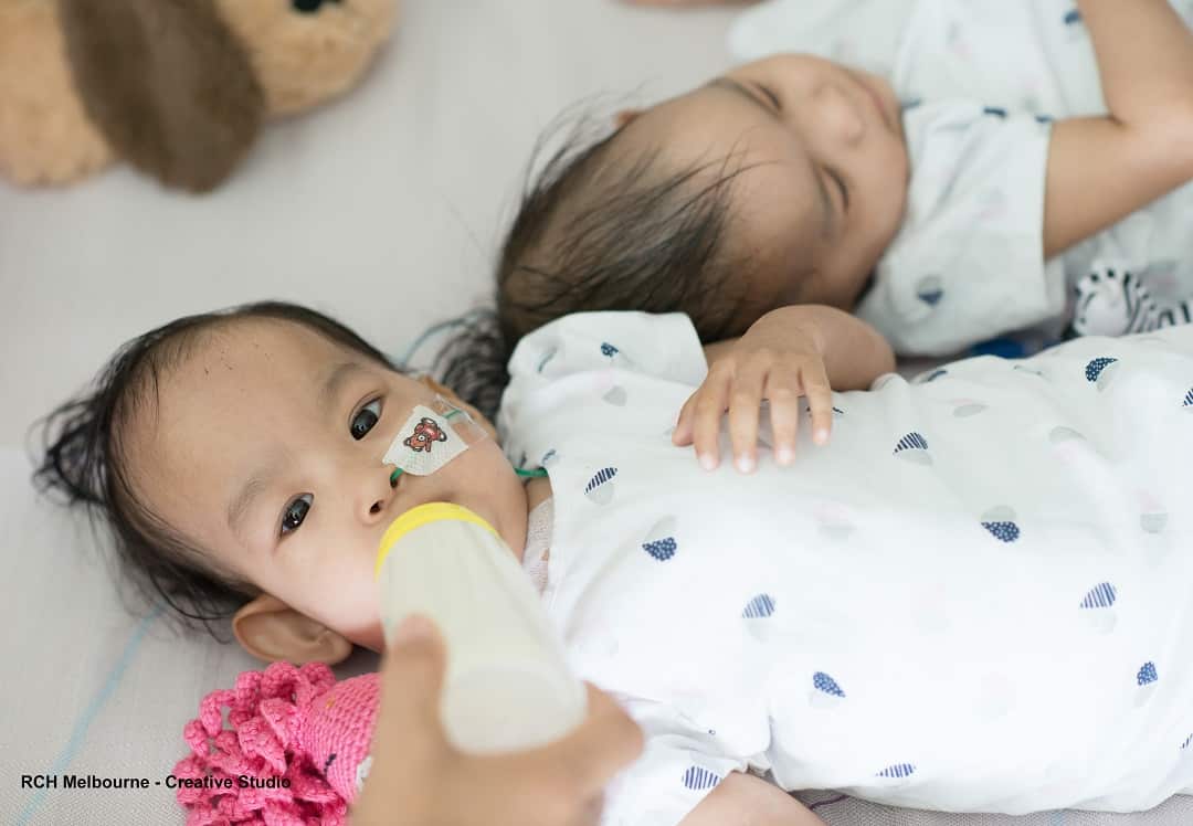 The twins are recovering well from their operation at the Royal Children's Hospital in Melbourne.