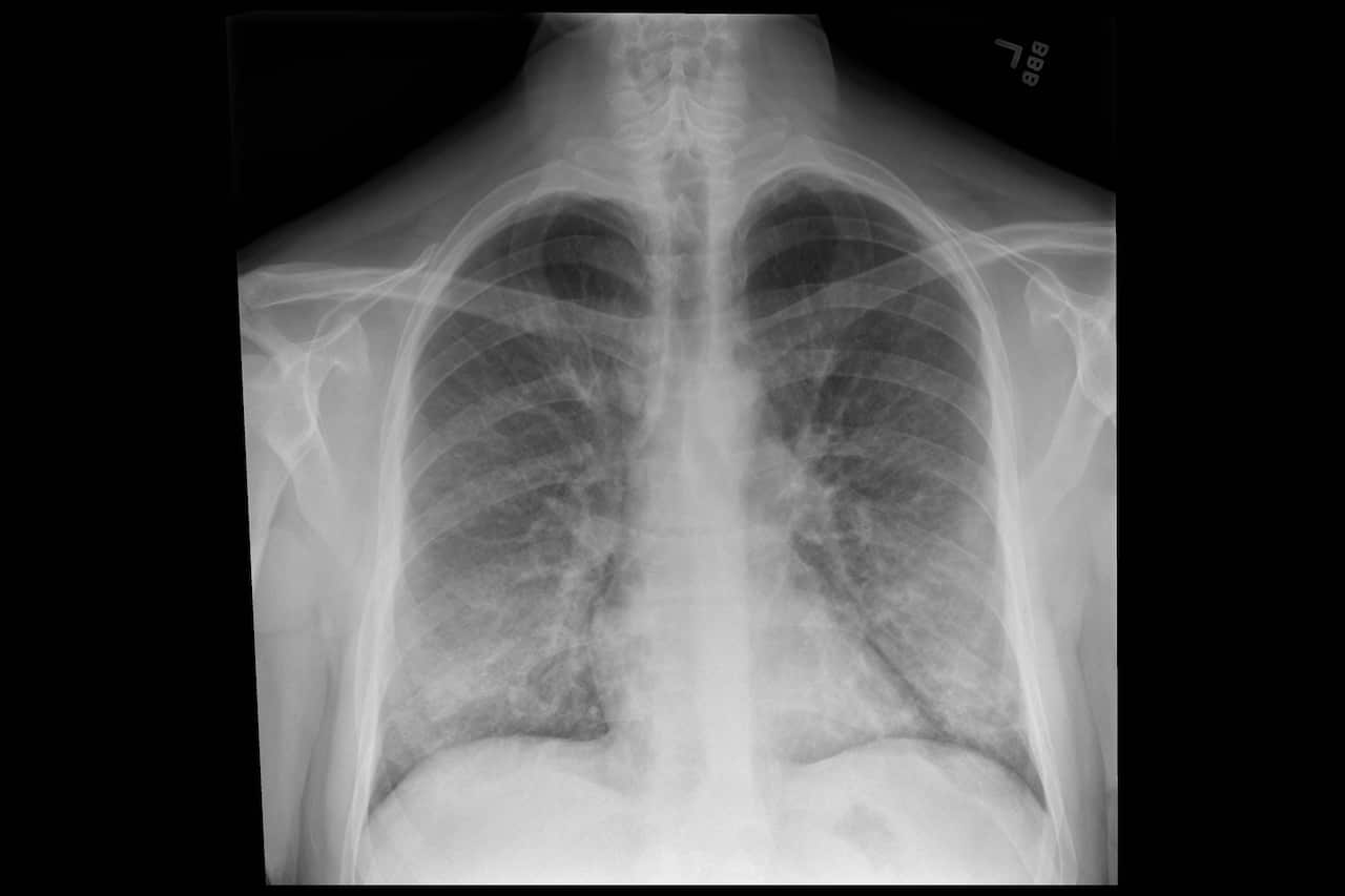 An X-ray of a patient with a vaping habit, showing lung damage. 