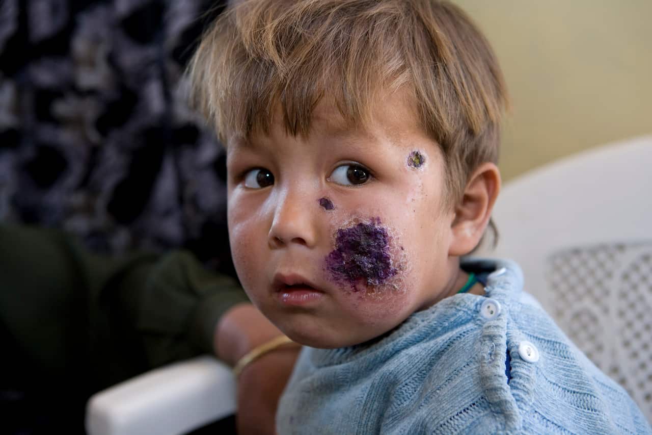 Feature about Leishmaniasis in Afghanistan.
