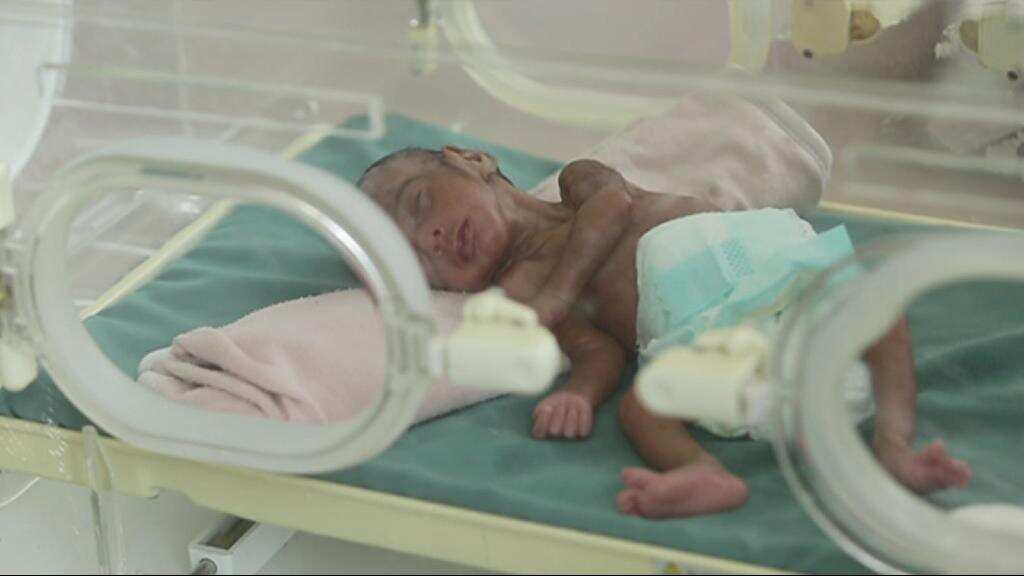Footage gathered by Save the Children shows babies aged between three and twelve months fighting for life in intensive care units at Al-Sabeen Hospital in the capital Sana’a.
