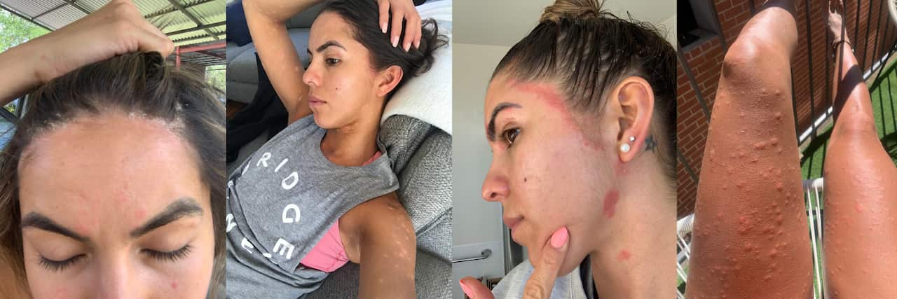 Megan shares her journey with psoriasis publicly so that she can raise awareness of the condition and offer comfort to others who might be on the same journey