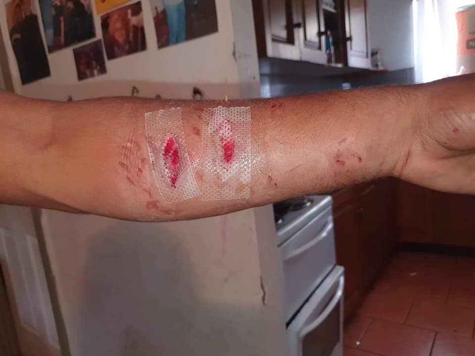 A badly mauled arm treated with plaster strips