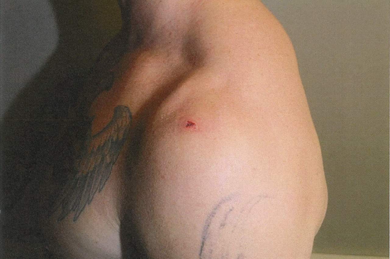 A side on view of Constable Rolfe, with a small puncture wound visible on his shoulder.