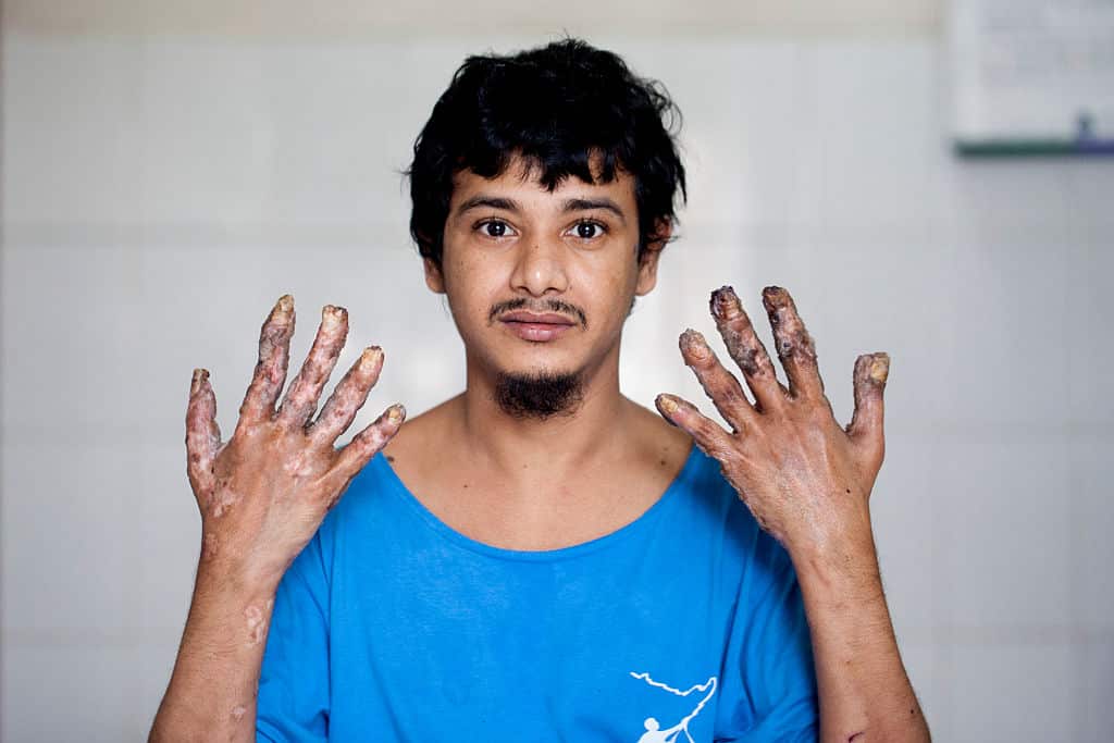 Abul Vajondar was identified with epidermodysplasia