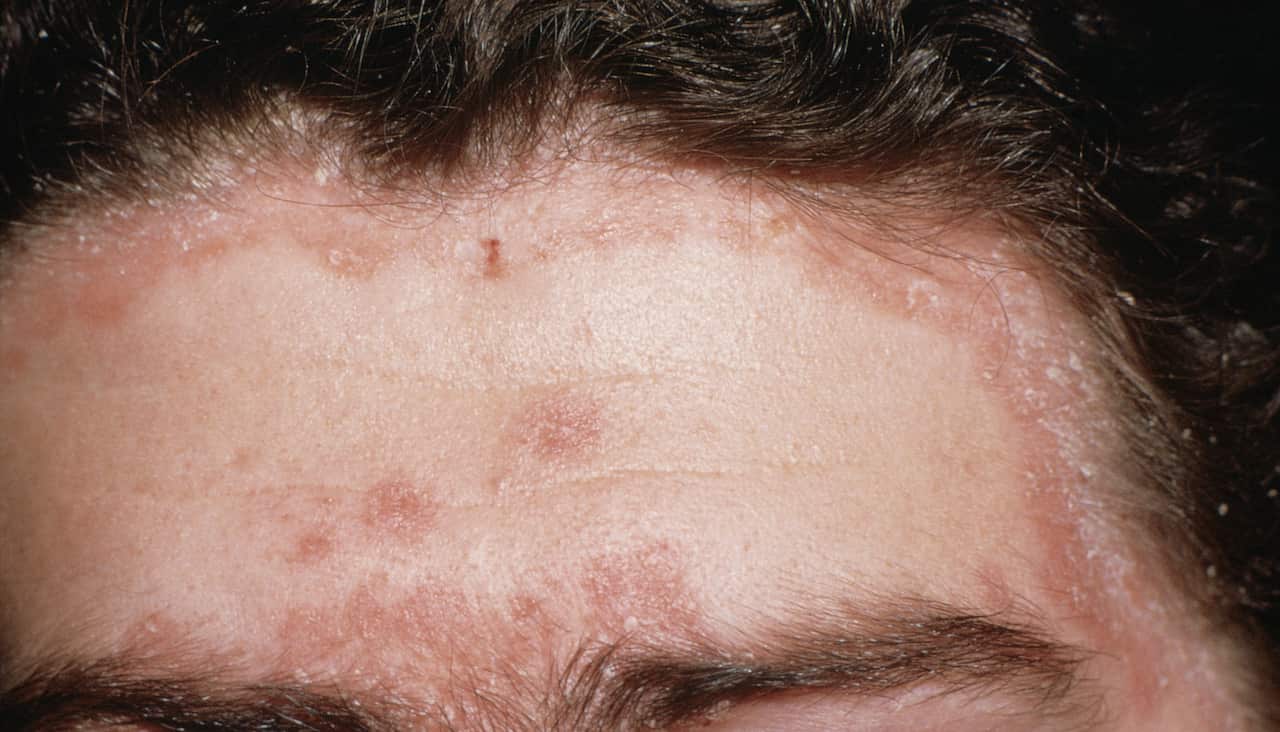 Psoriasis is a misunderstood condition. 