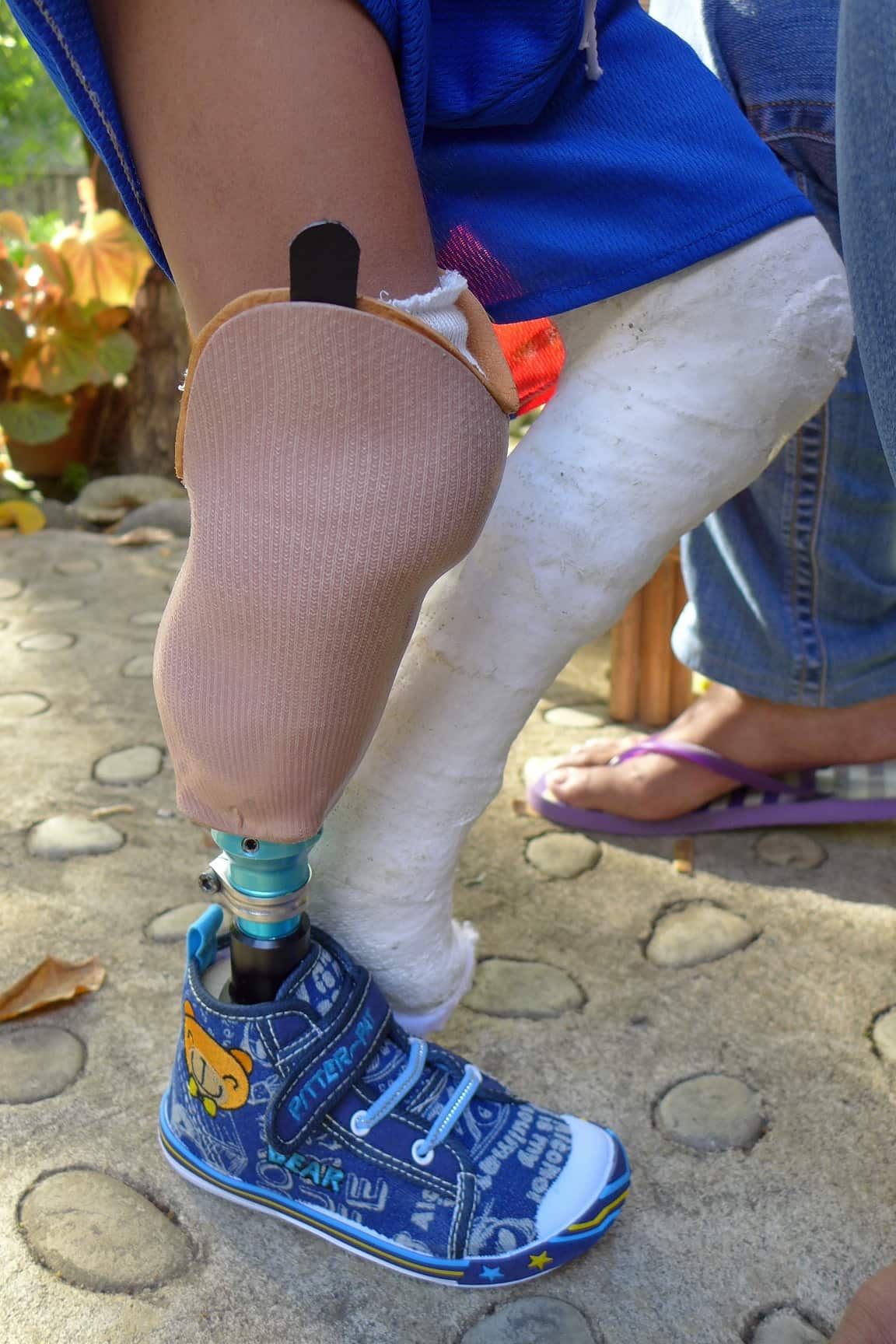  Udo Foerster, prosthetics, Australian volunteer, Bahatala