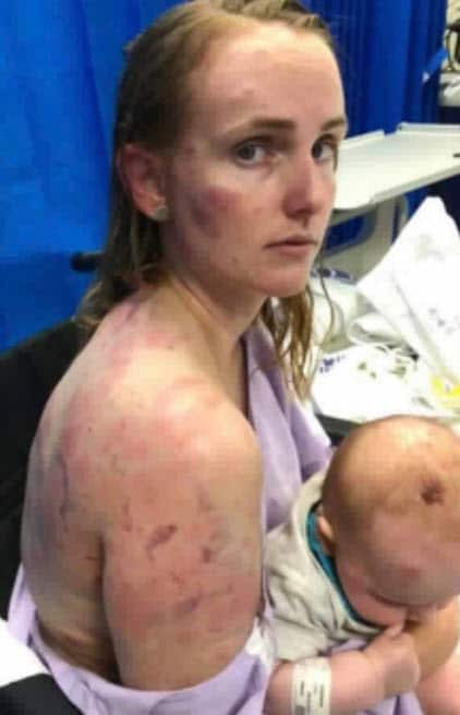 Kingaroy mother Fiona Simpson after the hail storm.