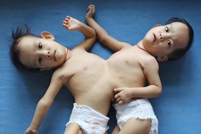 The health of the twins will be assessed before a surgical plan is made.