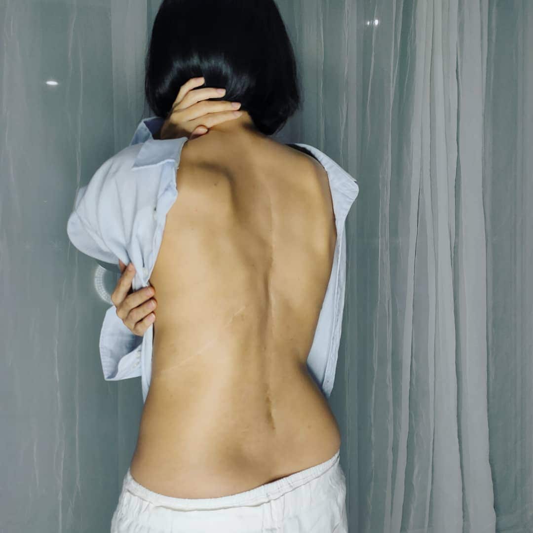 Elena Yakovleva from Sydney defeated scoliosis