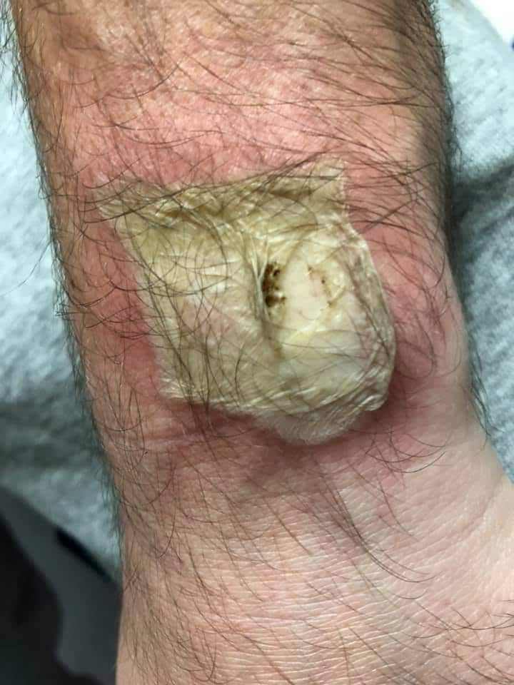 A man claims he sustained third-degree burns when his Fitbit exploded in his sleep