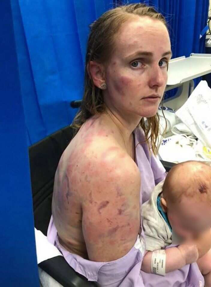 Fiona Simpson threw herself on top of her baby during a hailstorm near Kingaroy.