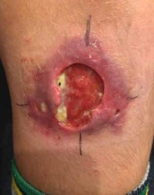 Mysterious flesh-eating ulcer cases soar on Mornington Peninsula.